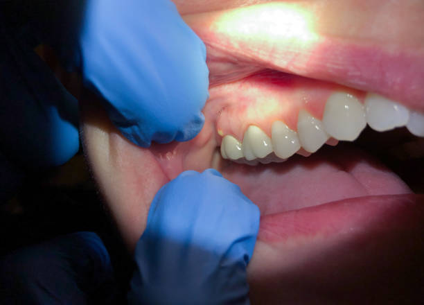 Best Emergency Dental Care for Broken or Chipped Teeth in Windy Hills, KY