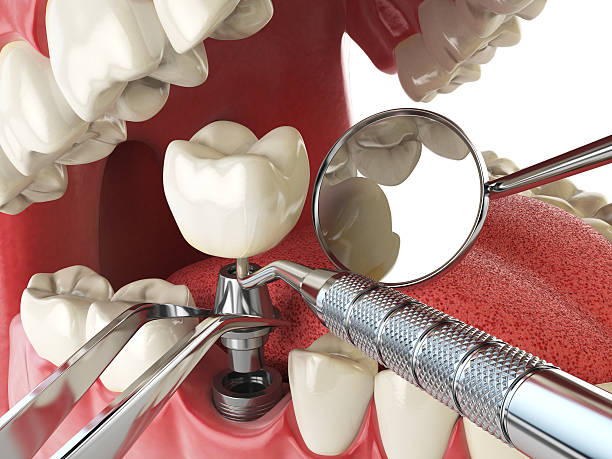 Best Emergency Dental Care for Broken or Chipped Teeth in Windy Hills, KY